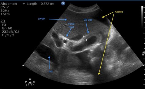 gallbladder wall thickness on ultrasound